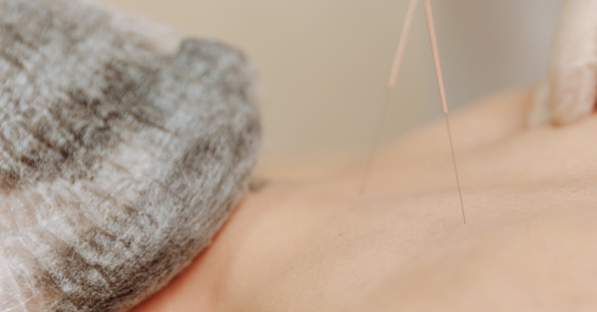 Natural Pain Relief: Acupuncture for Neuropathic Pain